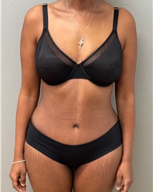 Tummy Tuck After Photo by Keshav Magge, MD; ,  - Case 50517