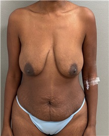 Tummy Tuck Before Photo by Keshav Magge, MD; ,  - Case 50517