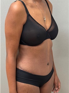 Tummy Tuck After Photo by Keshav Magge, MD; ,  - Case 50517