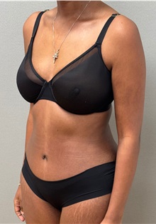 Tummy Tuck After Photo by Keshav Magge, MD; ,  - Case 50517