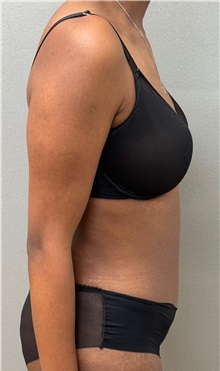 Tummy Tuck After Photo by Keshav Magge, MD; ,  - Case 50517