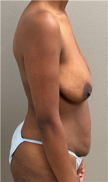 Tummy Tuck Before Photo by Keshav Magge, MD; ,  - Case 50517