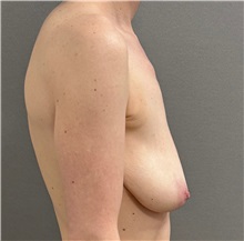 Breast Lift Before Photo by Keshav Magge, MD; ,  - Case 50520