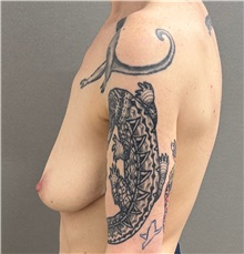 Breast Lift Before Photo by Keshav Magge, MD; ,  - Case 50520