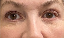 Eyelid Surgery After Photo by Keshav Magge, MD; ,  - Case 50519