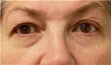 Eyelid Surgery Before Photo by Keshav Magge, MD; ,  - Case 50519