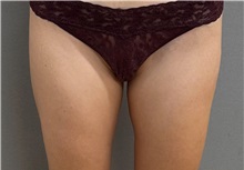 Liposuction After Photo by Keshav Magge, MD; ,  - Case 50521