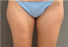 Liposuction Before Photo by Keshav Magge, MD; ,  - Case 50521