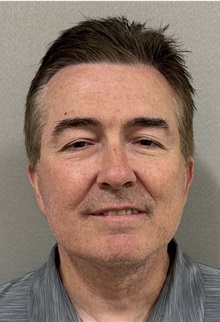 Neck Lift After Photo by Keshav Magge, MD; ,  - Case 50522