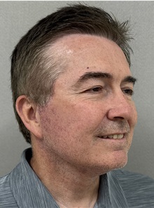 Neck Lift After Photo by Keshav Magge, MD; ,  - Case 50522