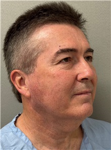 Neck Lift Before Photo by Keshav Magge, MD; ,  - Case 50522