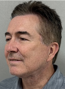 Neck Lift After Photo by Keshav Magge, MD; ,  - Case 50522