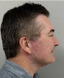 Neck Lift After Photo by Keshav Magge, MD; ,  - Case 50522