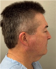 Facelift Before Photo by Keshav Magge, MD; ,  - Case 50523
