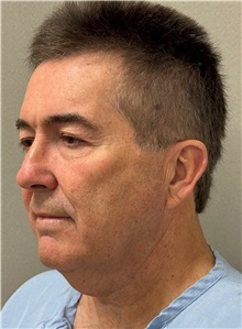 Facelift Before Photo by Keshav Magge, MD; ,  - Case 50523