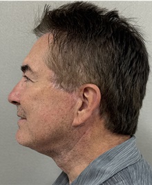 Facelift After Photo by Keshav Magge, MD; ,  - Case 50523