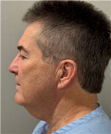 Facelift Before Photo by Keshav Magge, MD; ,  - Case 50523
