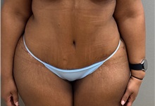 Tummy Tuck After Photo by Keshav Magge, MD; ,  - Case 50524