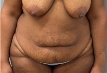 Tummy Tuck Before Photo by Keshav Magge, MD; ,  - Case 50524