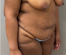 Tummy Tuck Before Photo by Keshav Magge, MD; ,  - Case 50524