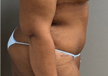 Tummy Tuck After Photo by Keshav Magge, MD; ,  - Case 50524