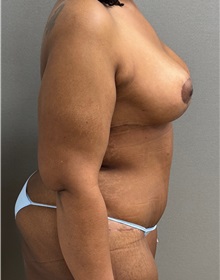 Mommy Makeover After Photo by Keshav Magge, MD; ,  - Case 50525