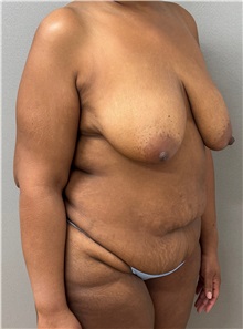 Mommy Makeover Before Photo by Keshav Magge, MD; ,  - Case 50525