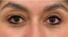 Eyelid Surgery After Photo by Keshav Magge, MD; ,  - Case 50526