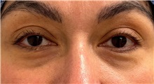 Eyelid Surgery Before Photo by Keshav Magge, MD; ,  - Case 50526