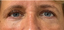 Eyelid Surgery After Photo by Keshav Magge, MD; ,  - Case 50541