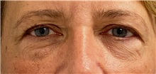 Eyelid Surgery Before Photo by Keshav Magge, MD; ,  - Case 50541