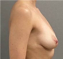 Breast Lift Before Photo by Keshav Magge, MD; ,  - Case 50543