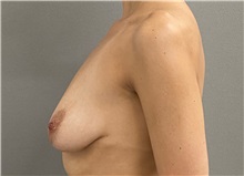 Breast Lift Before Photo by Keshav Magge, MD; ,  - Case 50543