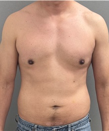 Male Breast Reduction After Photo by Keshav Magge, MD; ,  - Case 50544