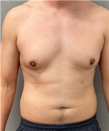Male Breast Reduction Before Photo by Keshav Magge, MD; ,  - Case 50544