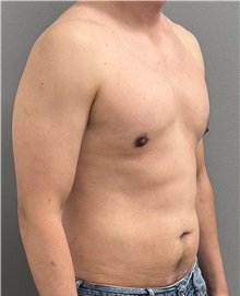 Male Breast Reduction After Photo by Keshav Magge, MD; ,  - Case 50544