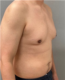 Male Breast Reduction Before Photo by Keshav Magge, MD; ,  - Case 50544