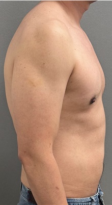 Male Breast Reduction After Photo by Keshav Magge, MD; ,  - Case 50544