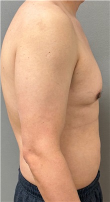 Male Breast Reduction Before Photo by Keshav Magge, MD; ,  - Case 50544