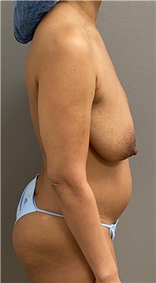 Mommy Makeover Before Photo by Keshav Magge, MD; ,  - Case 50548