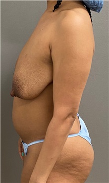 Mommy Makeover Before Photo by Keshav Magge, MD; ,  - Case 50548