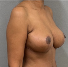 Breast Reduction After Photo by Keshav Magge, MD; ,  - Case 50549