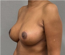 Breast Reduction After Photo by Keshav Magge, MD; ,  - Case 50549