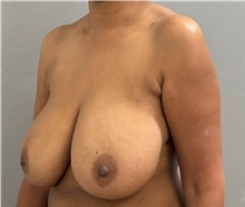 Breast Reduction Before Photo by Keshav Magge, MD; ,  - Case 50549