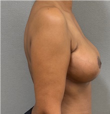 Breast Reduction After Photo by Keshav Magge, MD; ,  - Case 50549