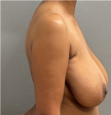 Breast Reduction Before Photo by Keshav Magge, MD; ,  - Case 50549