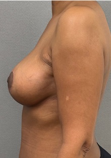 Breast Reduction After Photo by Keshav Magge, MD; ,  - Case 50549