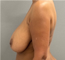 Breast Reduction Before Photo by Keshav Magge, MD; ,  - Case 50549
