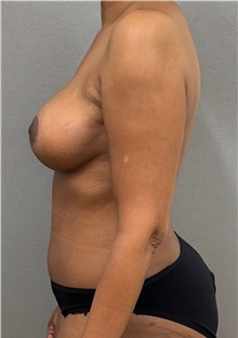 Mommy Makeover After Photo by Keshav Magge, MD; ,  - Case 50551