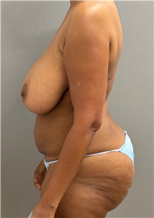 Mommy Makeover Before Photo by Keshav Magge, MD; ,  - Case 50551